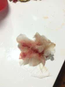 男性尿血的危害 男性尿血的危害 尿血的危害性