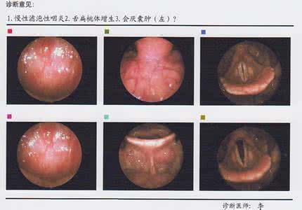 滤泡性咽炎治疗方法 滤泡性咽炎治疗方法 滤泡性咽炎治疗方法 滤泡性咽炎传染方式