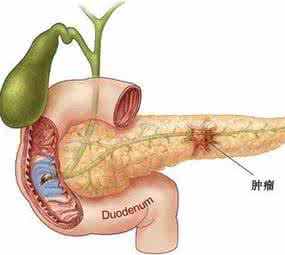 胰腺囊肿怎么治疗 胰腺囊肿 胰腺囊肿怎么治疗