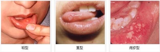 口腔溃疡吃什么好得快 口腔溃疡吃啥好得快 口腔溃疡怎么好得快？口腔溃疡不能吃什么