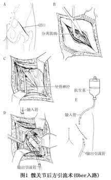 化脓性膝关节炎 小儿急性化脓性膝关节炎1方
