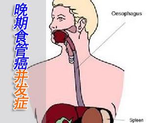 食管癌中晚期症状 食管癌有症状多已到了中晚期