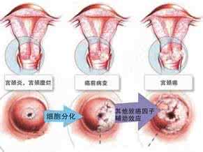 宫颈糜烂消融手术 宫颈消融术后需要注意什么？