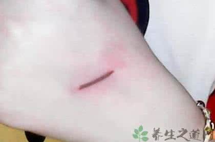 化脓的伤口怎么处理 伤口化脓 伤口化脓的时候这样处理