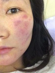 吃虾皮肤过敏怎么办 吃虾皮肤过敏吗 皮肤过敏的护理方法是有哪些