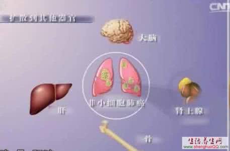 肺腺癌到底能不能治愈 肺癌离我们到底有多远