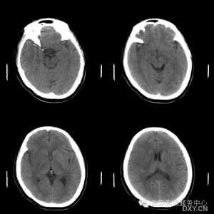 脑梗塞影像学表现 超早期脑梗塞的CT影像表现及诊断