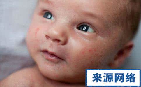 食物过敏症状如何谖解 食物过敏症状 如何分辨食物过敏