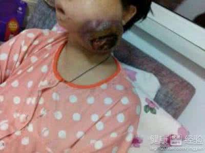 治疗淋巴癌最好的医院 淋巴癌能治好吗 如何治疗淋巴癌