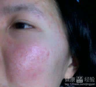 换季皮肤过敏的症状 换季皮肤过敏 皮肤过敏症状有哪些