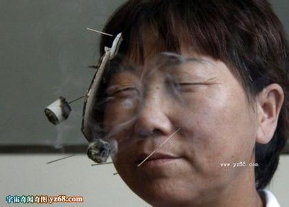 面瘫的后遗症能恢复吗 面瘫后遗症能治好 针灸疗法恢复快