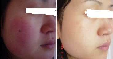 去除脸部红血丝多少钱 去除红血丝多少钱 怎样去脸部红血丝