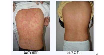 教学方法多样化 牛皮癣怎么治疗 治疗牛皮癣方法多样化