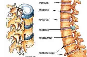 颈椎骨质增生怎么治疗 颈椎骨质增生怎么治疗 患有颈椎增生该怎么治疗