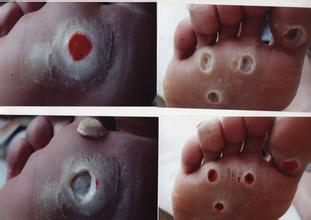 鸡眼是怎么形成的 鸡眼是怎么形成的呢