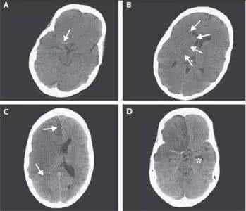脑梗死mri影像表现 手把手教程：脑梗死影像读片入门