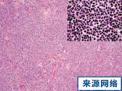 肛门湿疹症状及治疗 肛门湿疹症状 肛门湿疹怎么治疗