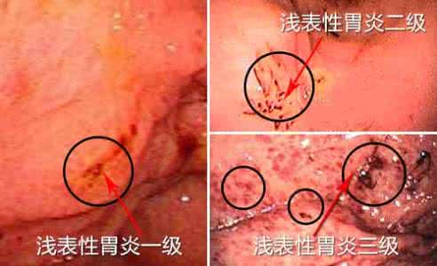 非萎缩性胃炎会癌变吗 非萎缩性胃炎会癌变吗 为什么会有萎缩性胃炎