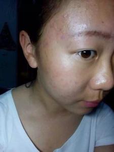 去痘印面膜 脸上长痘痘怎么去痘印 自制去痘印面膜，淡化痘痘痘印，告别痘痘和痘印