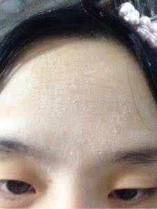 皮肤起皮是怎么回事 脸上起皮是怎么回事 脸上皮肤起皮怎么办