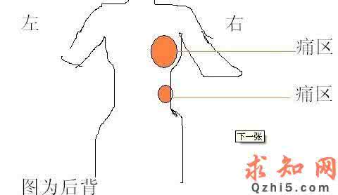 后背疼痛看什么科 后背痛看什么科？