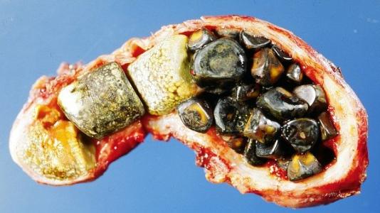 胆结石在什么位置 胆结石介绍