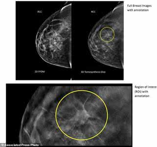 乳腺癌 3D乳腺X光提高乳腺癌检出率