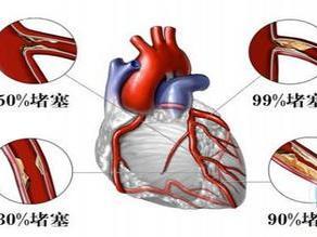 彻底根治冠心病的偏方 冠心病