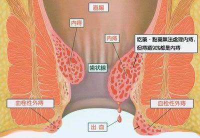 内痔外痔混合痔 十男九痔，十女十痔？内痔外痔混合痔都要怎么治？