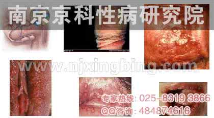 湿疣疱疹 尖锐湿疣疱疹
