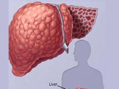 肝纤维化能治愈吗 肝纤维化