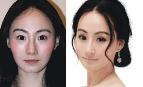 红眼药膏能治红血丝吗 脸上红血丝怎么修复