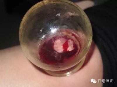 中医拔罐放血疗法 中医各种罐法详解,看看有没有你不知道的