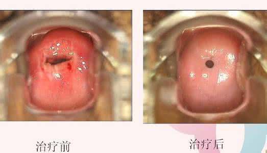 人流会导致宫颈糜烂吗 人流会导致宫颈糜烂吗 多次人流会导致宫颈糜烂吗