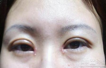 开眼角恢复时间 开眼角恢复时间 开眼角要恢复多久