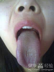 假性疣湿早期症状图片 病毒疣的早期症状图片 病毒疣会有哪些早期症状