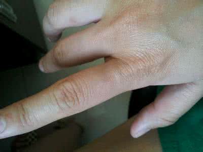 青霉素过敏处理方法 青霉素过敏怎么办 缓解过敏有方法