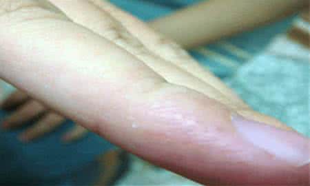 汗疱疹的土法根治方法 汗疱疹的治疗偏方 【汗疱疹的土法根治方法】汗疱疹的治疗偏方