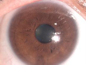 羌活胜湿汤 五官科方剂 羌活胜风汤治疗病毒性角膜炎