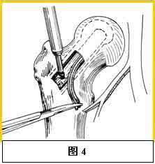 股骨头血管植入术价格 股骨头血管植入术价格 植入单纯血管束、感觉神经束的组织工程骨修复大段骨缺损_图文