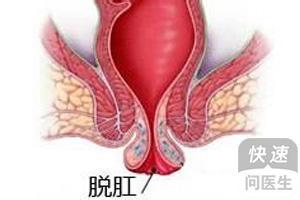 有痔疮肛门瘙痒 痔疮肛门瘙痒 因为有痔疮肛门瘙痒？