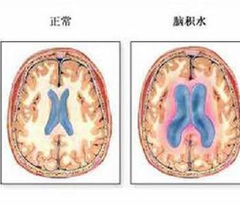 新生儿脑水肿 新生儿脑水肿 它的病因是什么