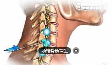 颈椎骨质增生治疗方法 颈椎骨质增生的治疗方法 颈椎骨质增生预防