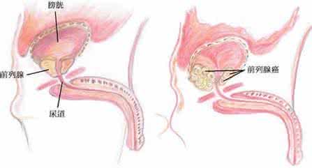 前列腺癌晚期能活几年 前列腺癌 前列腺癌晚期