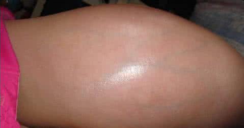 滑膜肉瘤症状 滑膜肉瘤症状明显吗？有哪些？