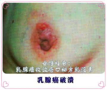 治疗乳腺癌的祖传秘方 女性福音:乳腺癌不必忧三代祖传秘方解愁忧