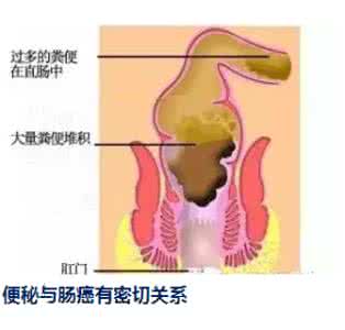 长期便秘会得癌症吗 便秘是癌症的种子，99%的人都不知道！