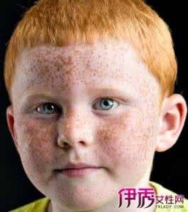 小孩脸上有黑斑 小孩脸上有黑斑 小孩脸上黑斑怎么办?