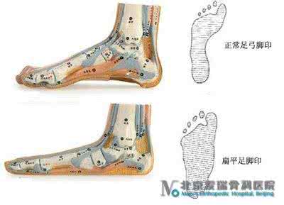 平足适合穿什么鞋子 平足适合穿什么鞋子?