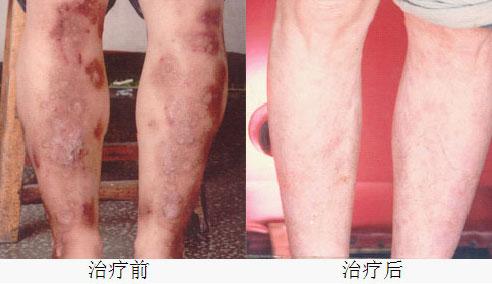 抗厌氧菌药物 银屑病止痒抗氧的药物 银屑病怎么止痒？